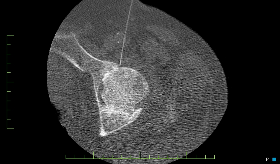 Figure 2 for case transfemoral artery steroid injection L hip